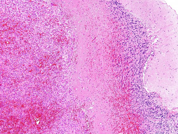 2B1 Hemangioblastoma, VHL (Case 2) H&E 4.jpg