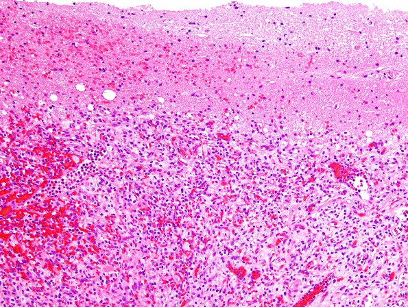 2B2 Hemangioblastoma, VHL (Case 2) H&E 3.jpg