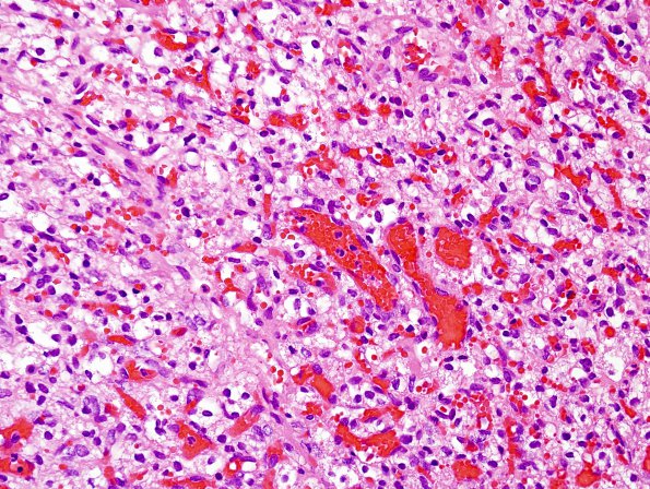 2B4 Hemangioblastoma, VHL (Case 2) H&E 8.jpg