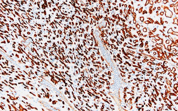 2C1 Hemangioblastoma, VHL (Case 2) CD34 20X