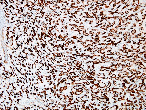 2C2 Hemangioblastoma, VHL (Case 2) CD34 2.jpg