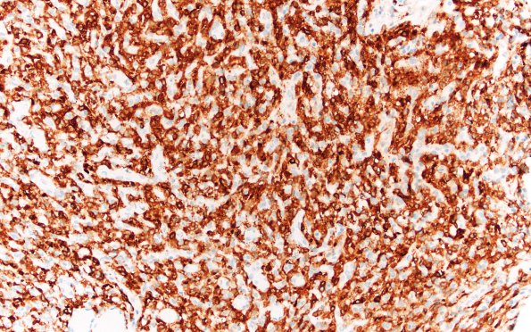 2D1 Hemangioblastoma, VHL (Case 2) Inhibin 20X