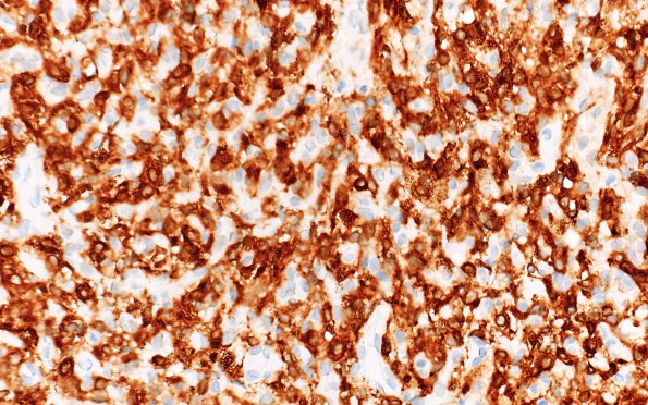 2D2 Hemangioblastoma, VHL (Case 2) Inhibin 40X