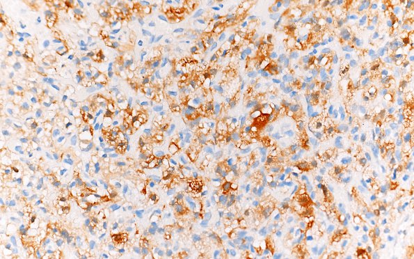 2E Hemangioblastoma, VHL (Case 2) S100 40X