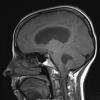 30A1 Hemangioblastoma (Case 30) T1 1