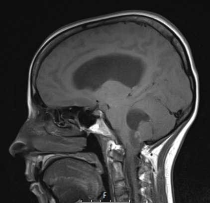 30A1 Hemangioblastoma (Case 30) T1 1