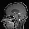 30A2 Hemangioblastoma (Case 30) T1W