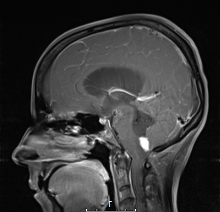 30A2 Hemangioblastoma (Case 30) T1W