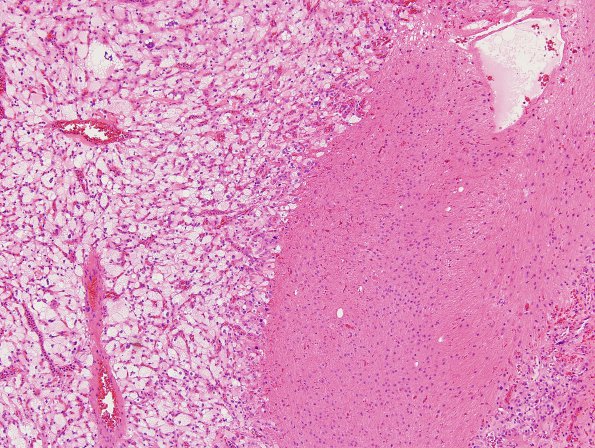 30B1 Hemangioblastoma (Case 30) H&E 2