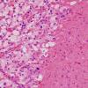 30B2 Hemangioblastoma (Case 30) H&E 1