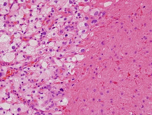 30B2 Hemangioblastoma (Case 30) H&E 1