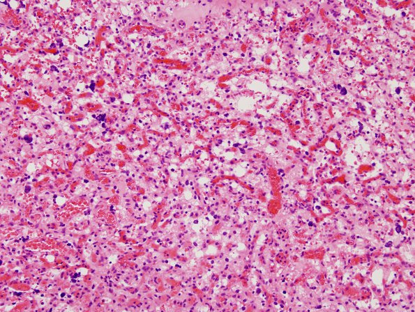 30B3 Hemangioblastoma (Case 30) H&E 3