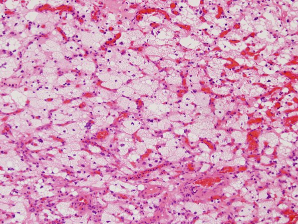 30B4 Hemangioblastoma (Case 30) H&E 5