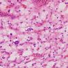 30B6 Hemangioblastoma (Case 30) H&E 9