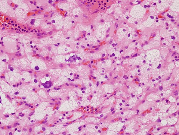 30B6 Hemangioblastoma (Case 30) H&E 9