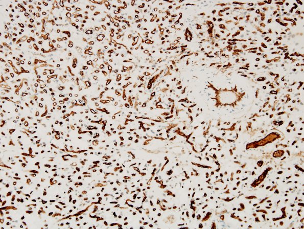 30C Hemangioblastoma (Case 30) CD34 2