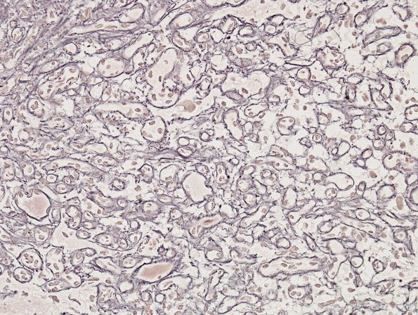 30D Hemangioblastoma (Case 30) Retic 3