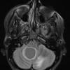 3A1 Hemangioblastoma (VHL, Case 3) FLAIR - Copy