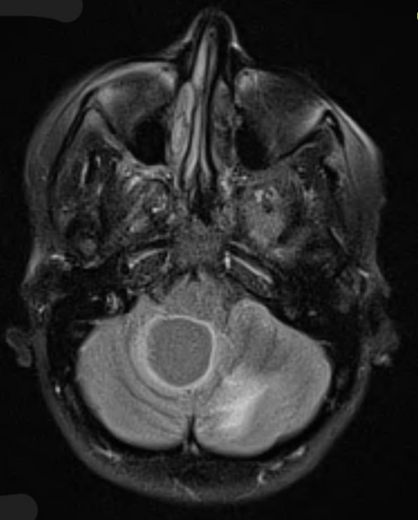 3A1 Hemangioblastoma (VHL, Case 3) FLAIR - Copy