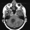 3A2 Hemangioblastoma (VHL, Case 3) T1 W 2 - Copy