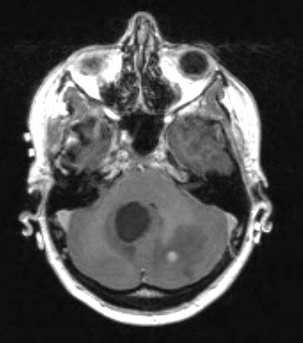 3A2 Hemangioblastoma (VHL, Case 3) T1 W 2 - Copy