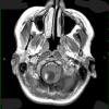 3A3 Hemangioblastoma (VHL, Case 3) T1 W 1 - Copy