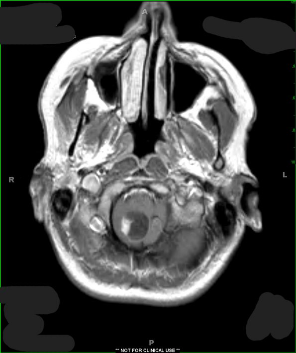 3A3 Hemangioblastoma (VHL, Case 3) T1 W 1 - Copy