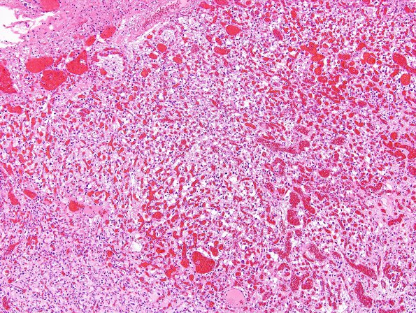 3B1 Hemangioblastoma (VHL, Case 3) H&E 3