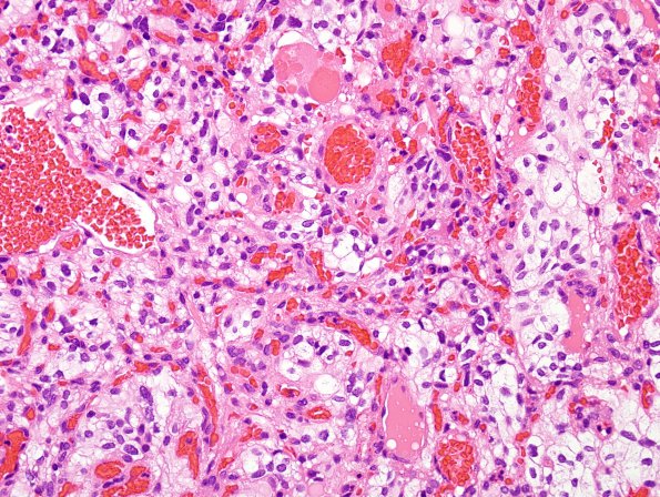 3B2 Hemangioblastoma (VHL, Case 3) H&E 1