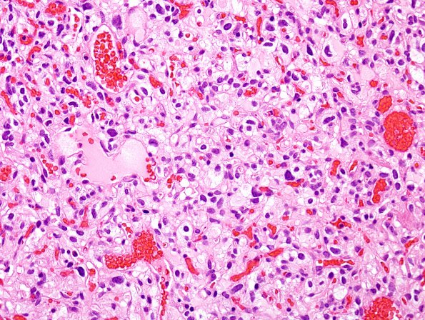 3B3 Hemangioblastoma (VHL, Case 3) H&E 2