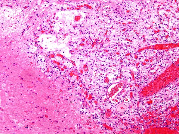 3B4 Hemangioblastoma (VHL, Case 3) H&E 5