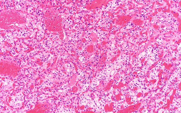 3B5 Hemangioblastoma (VHL, Case 3) H&E 20X