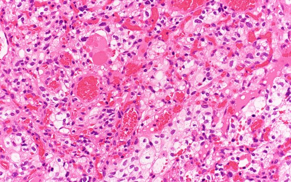 3B6 Hemangioblastoma (VHL, Case 3) H&E 40X