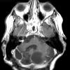 4A1 Hemangioblastoma (Case 4, VHL Dz) T1 W 1 - Copy