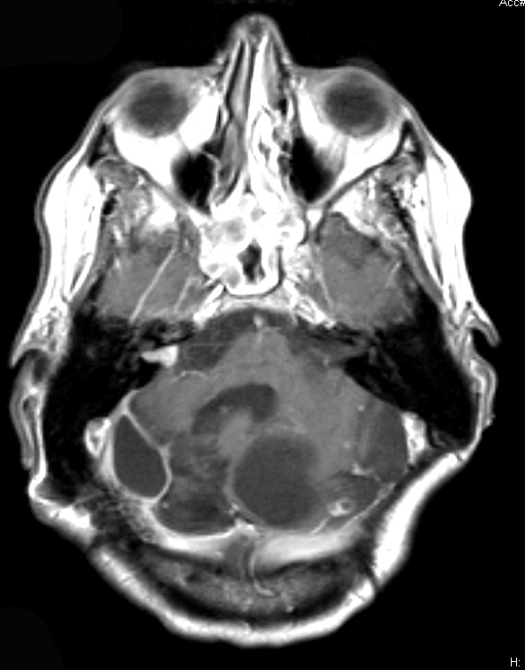 4A1 Hemangioblastoma (Case 4, VHL Dz) T1 W 1 - Copy