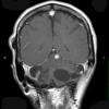 4A2 Hemangioblastoma (Case 4, VHL Dz) T1W 2 - Copy