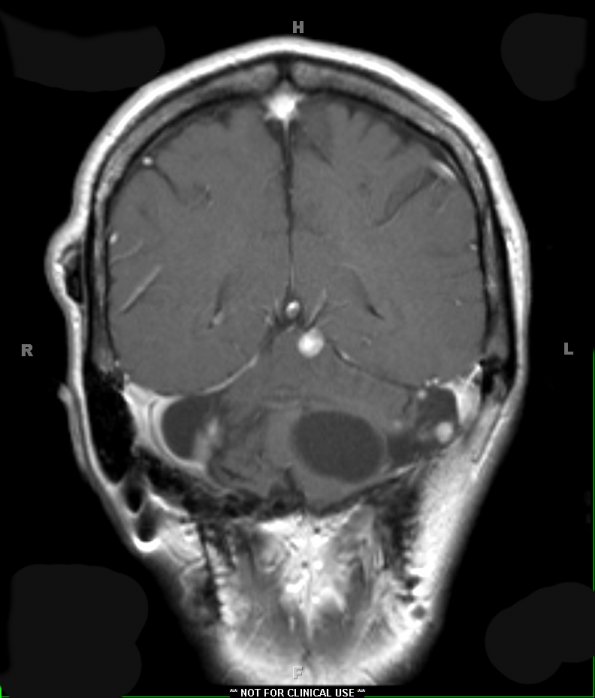 4A2 Hemangioblastoma (Case 4, VHL Dz) T1W 2 - Copy