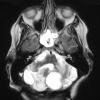 4A3 Hemangioblastoma (Case 4, VHL Dz) T2 W 1 - Copy