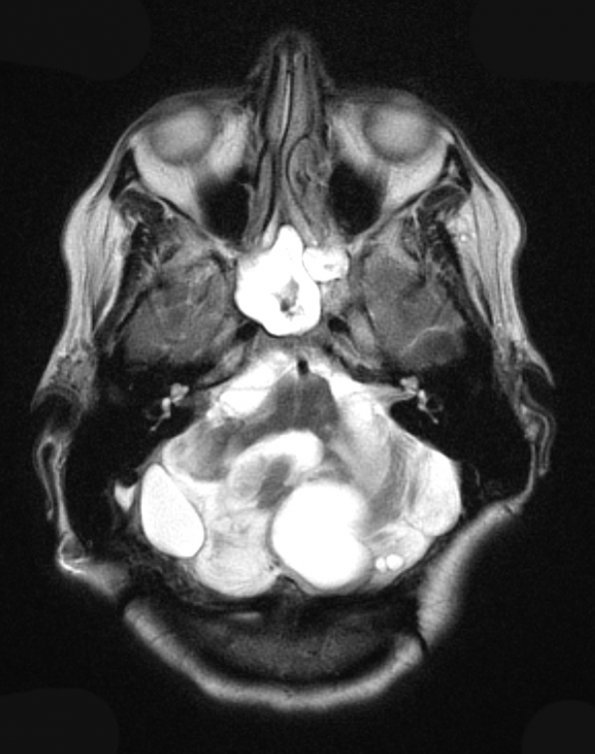 4A3 Hemangioblastoma (Case 4, VHL Dz) T2 W 1 - Copy