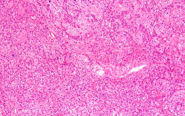 4B1 Hemangioblastoma (Case 4, VHL Dz) H&E 10X