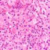 4B2 Hemangioblastoma (Case 4, VHL Dz) H&E 40X