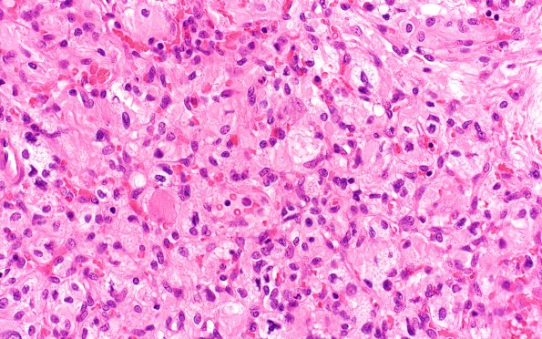 4B2 Hemangioblastoma (Case 4, VHL Dz) H&E 40X