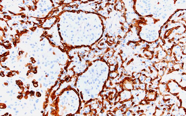 4C2 Hemangioblastoma (Case 4, VHL Dz) CD34 20X