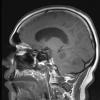 5A1 Hemangioblastoma, VHL (Case 5) T1 noC - Copy