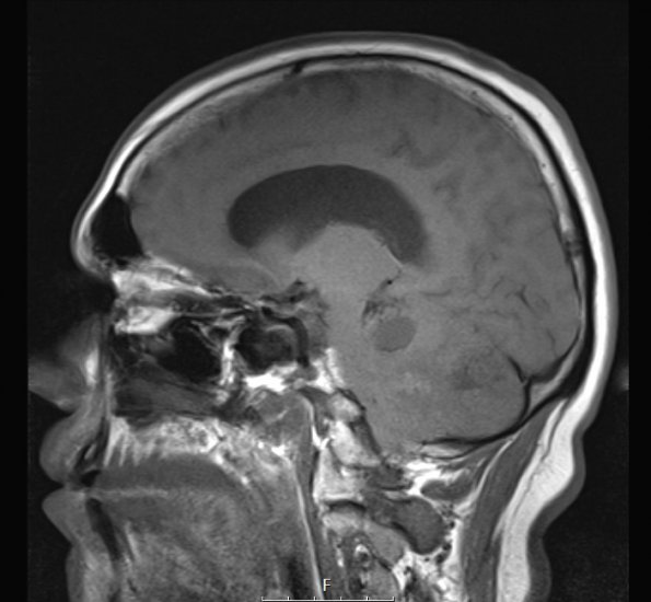 5A1 Hemangioblastoma, VHL (Case 5) T1 noC - Copy