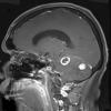 5A2 Hemangioblastoma, VHL (Case 5) T1 W 1 - Copy