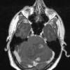 5A3 Hemangioblastoma, VHL (Case 5) T1 W 2 - Copy