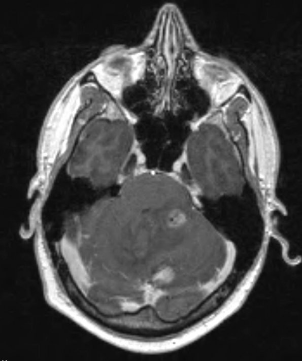 5A3 Hemangioblastoma, VHL (Case 5) T1 W 2 - Copy