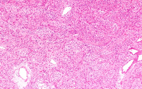 5B1 Hemangioblastoma, VHL (S10-49354) H&E 10X