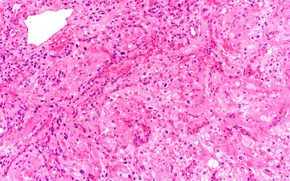 5B2 Hemangioblastoma, VHL (Case 5) H&E 20X